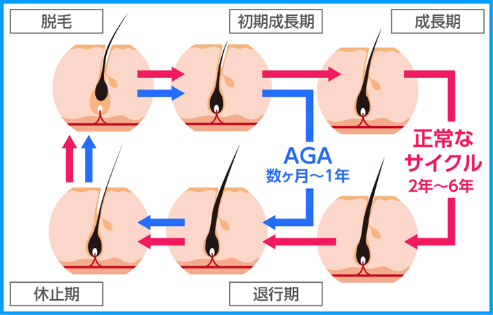 AGAの原因はヘアサイクルの乱れを示す画像
