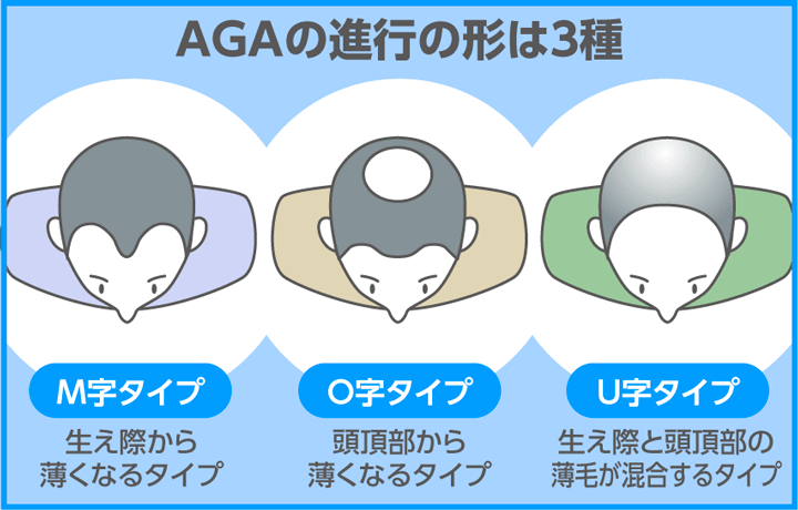 AGAの進行の形は3種類であることを示す画像